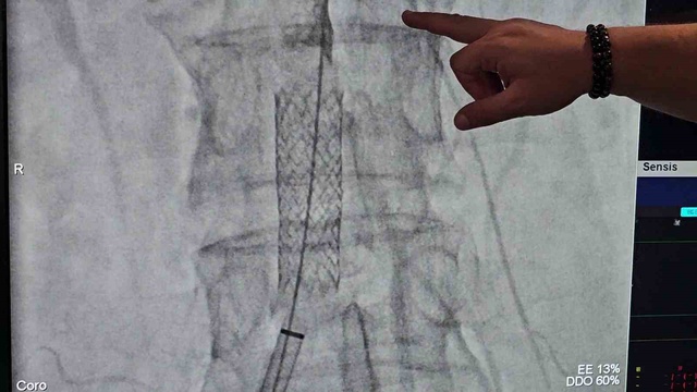 Zonguldak Ereğli'de öksürükle kalp damarı yırtılan kadın stentle hayata bağlandı
