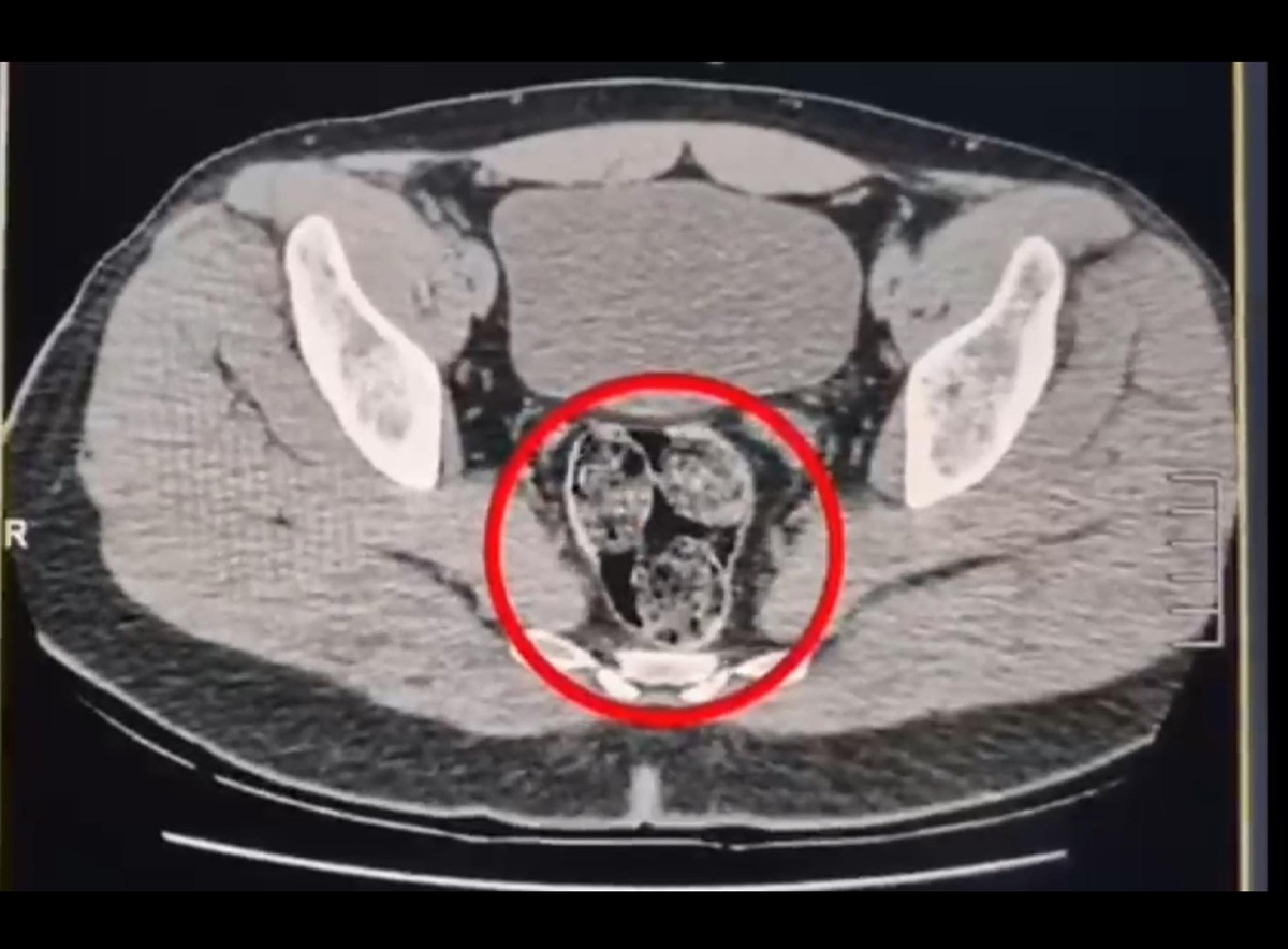 Kars\'ta otobüste 307,94 gram metamfetamin bulundu, 2 İranlı şüpheli tutuklandı