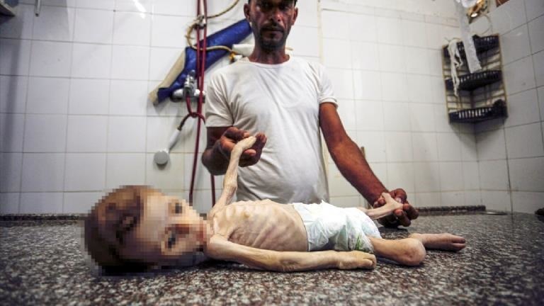 Gazze’de yetersiz beslenme ve tıbbi malzeme eksikliği nedeniyle 7 aylık bebek hayatını kaybetti